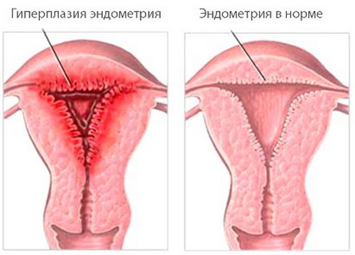 Гиперплазия эндометрия в менопаузе