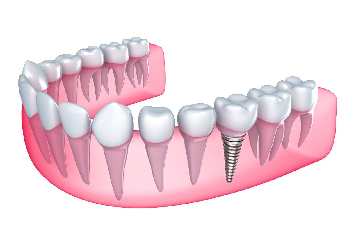 Восстановление улыбки: протезирование зубов на имплантах