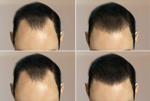 Пересадка волос: восстановление и улучшение внешности