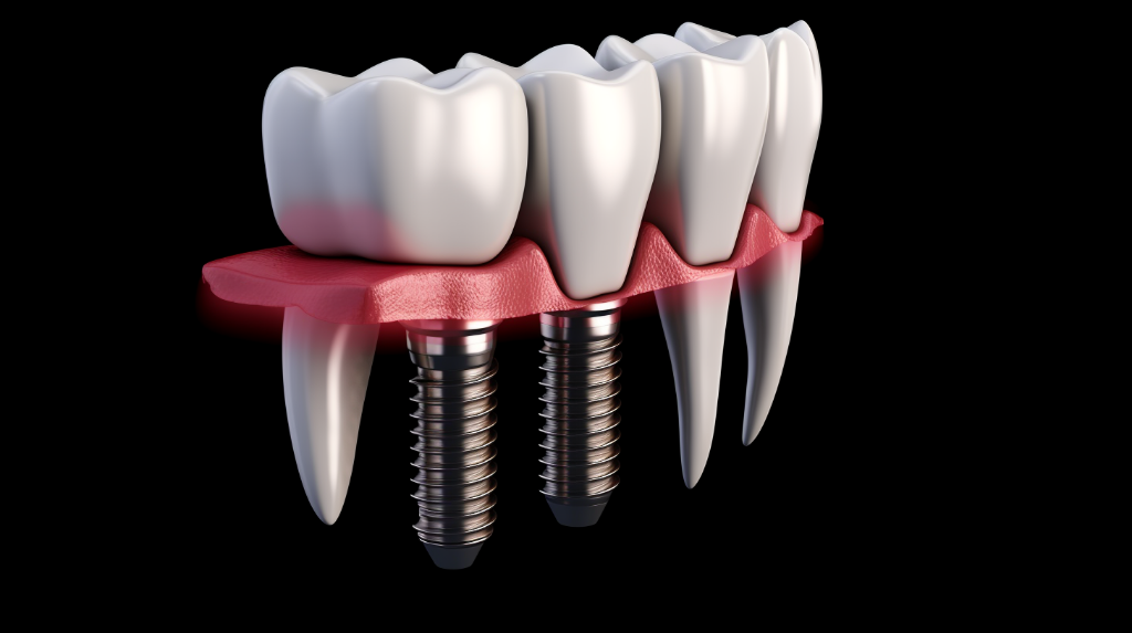 Что такое имплантация зубов All on 4? фото 1